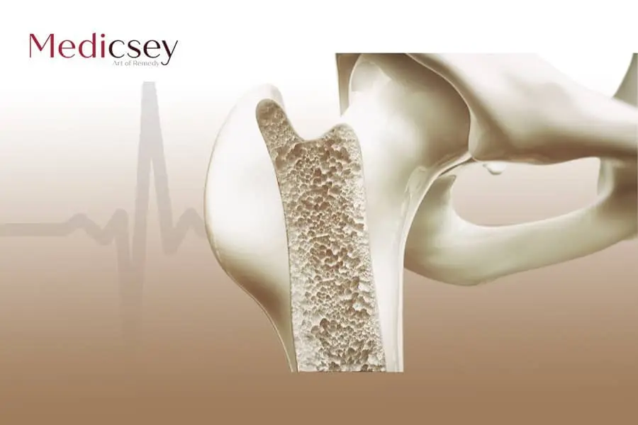 Osteoporosis in Turkey, its causes and treatment