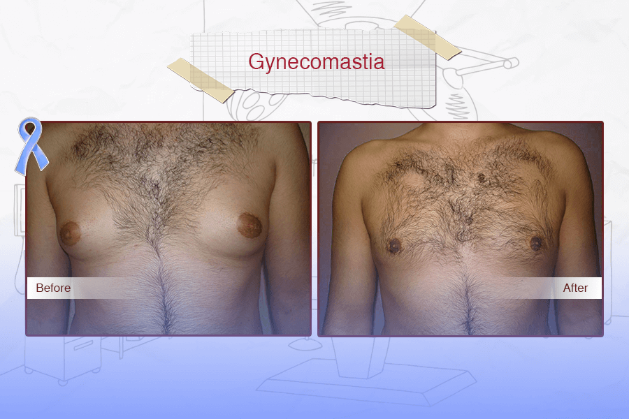 Gynecomastia