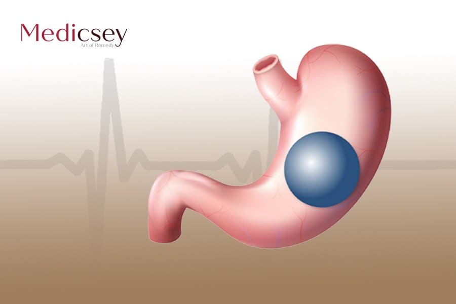 Advantages and disadvantages of the gastric balloon in Turkey 