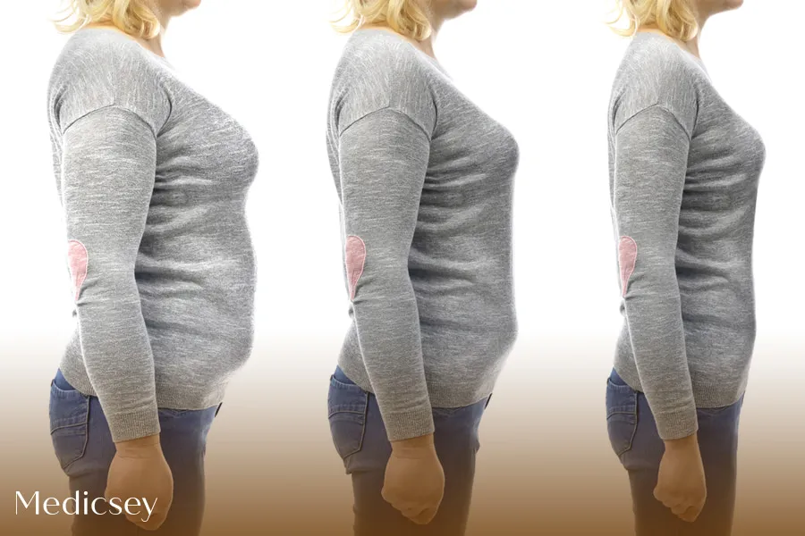 Tummy Tuck