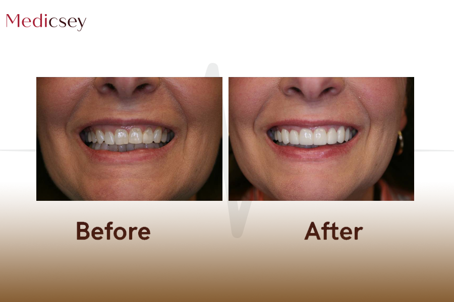 Porcelain Veneers