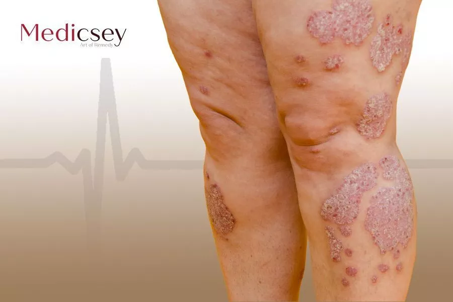 Causes and treatment of shingles in turkey