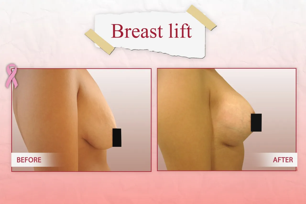Breast Lift