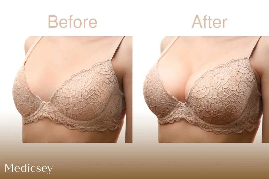  Breast Reduction