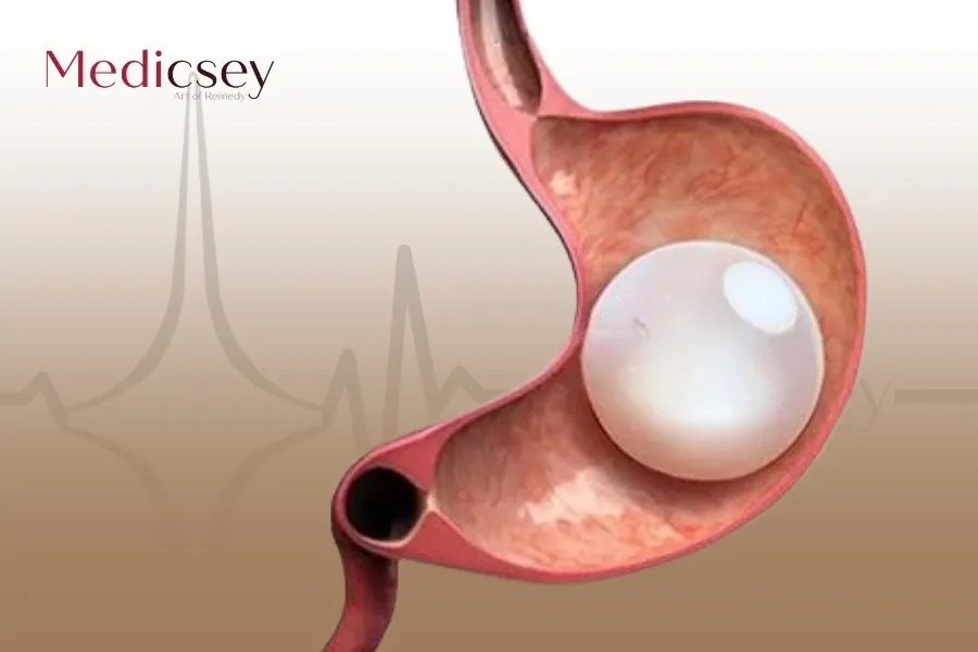 Gastric balloon in Syria: Is it a solution of excess obesity?