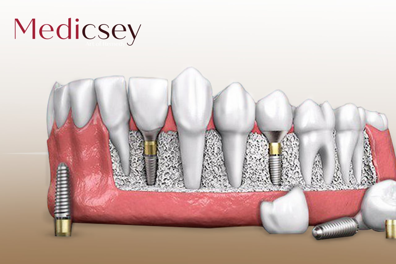 Best types of dental implant in turkey