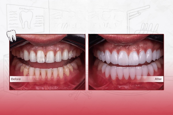 Lumineers Veneers