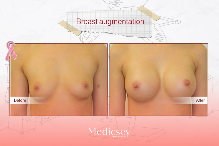 Breast Augmentation 