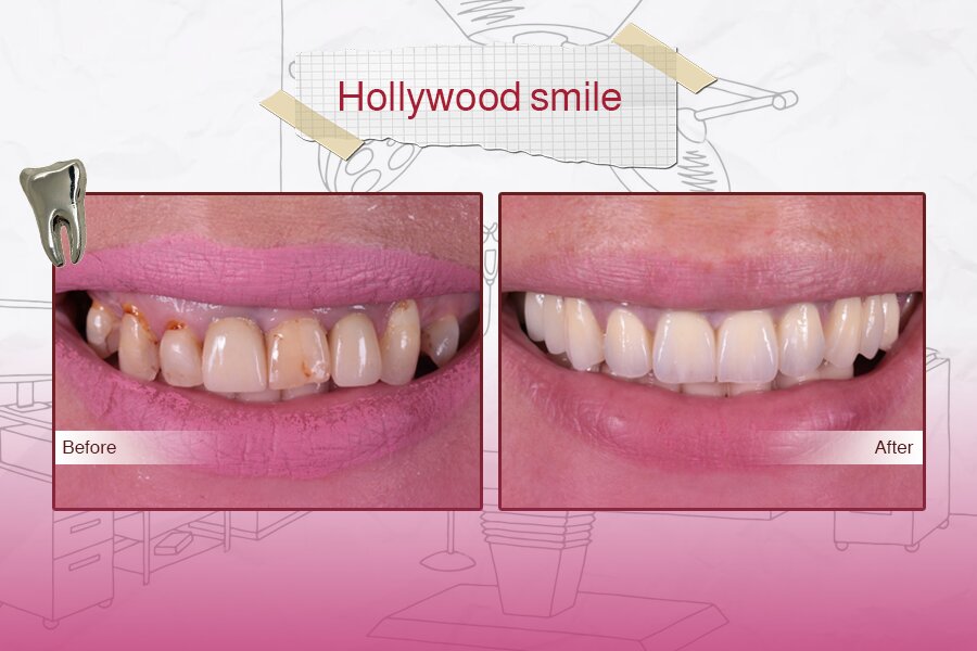 Blanchiment des dents