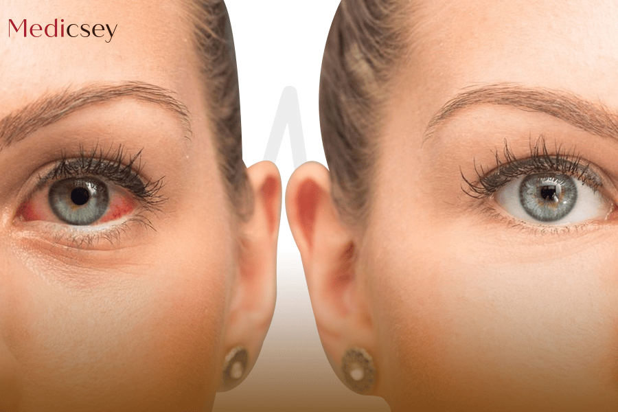 Retina treatment