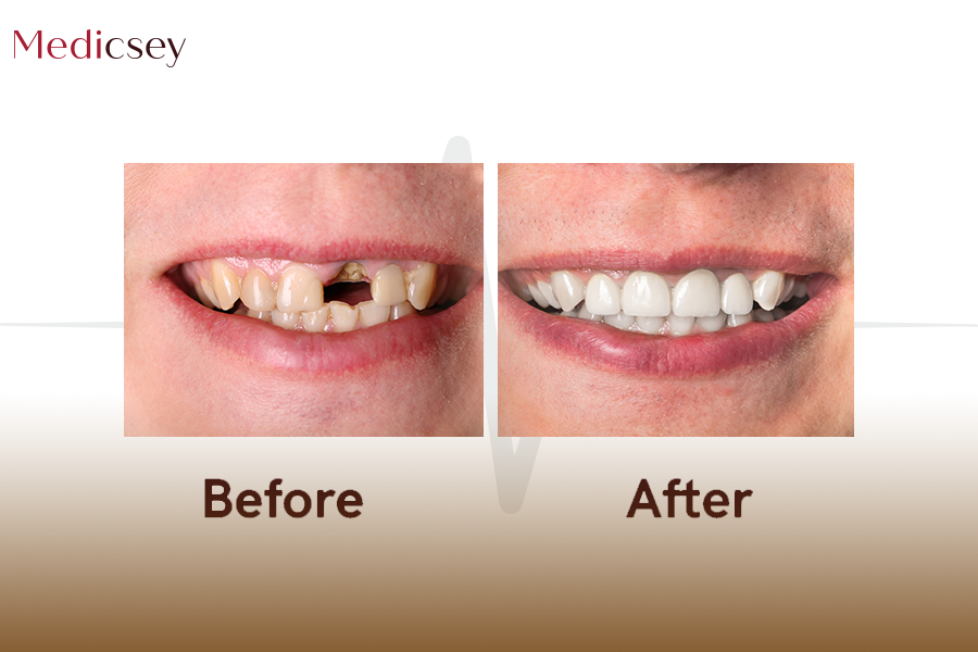 Root Canal Treatment