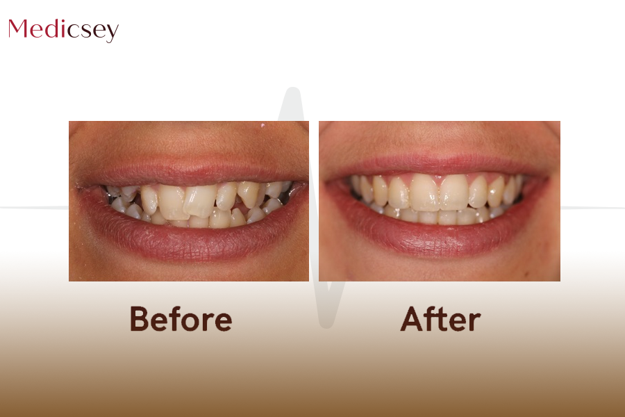 Dental Braces