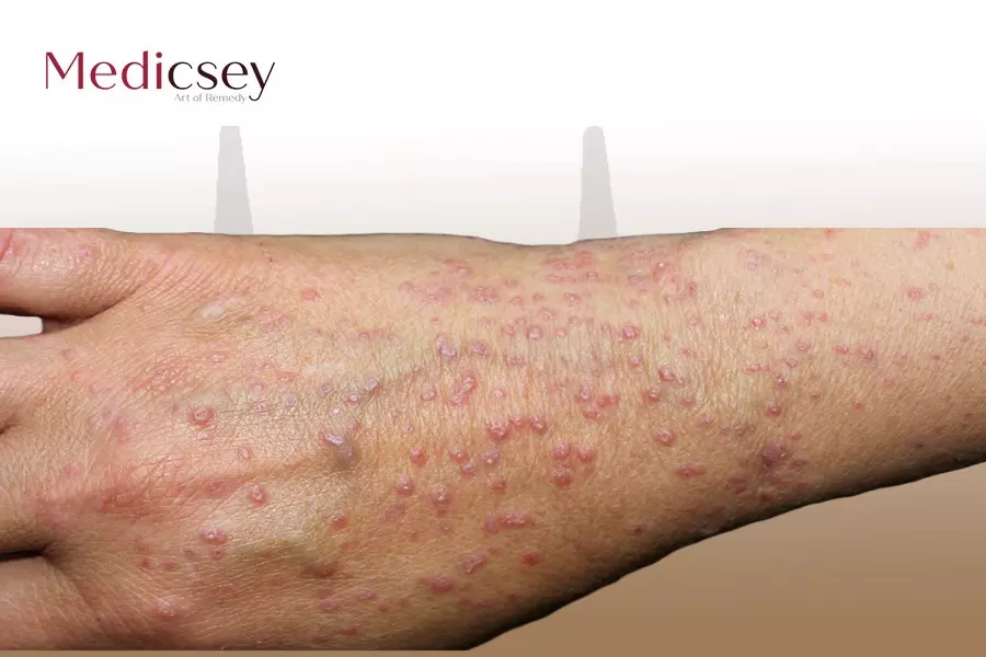 Causes and treatment of Lichen planus in turkey 