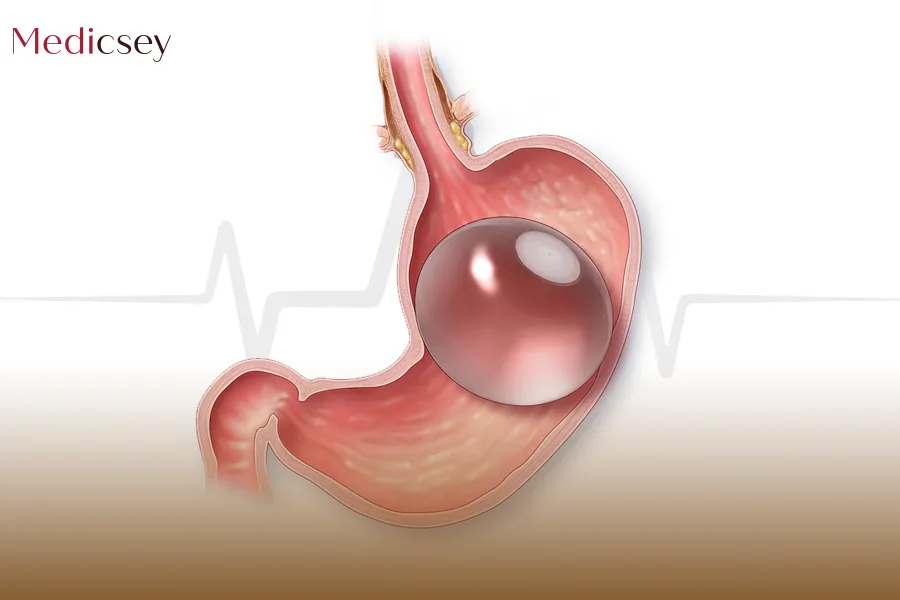 Gastric balloon