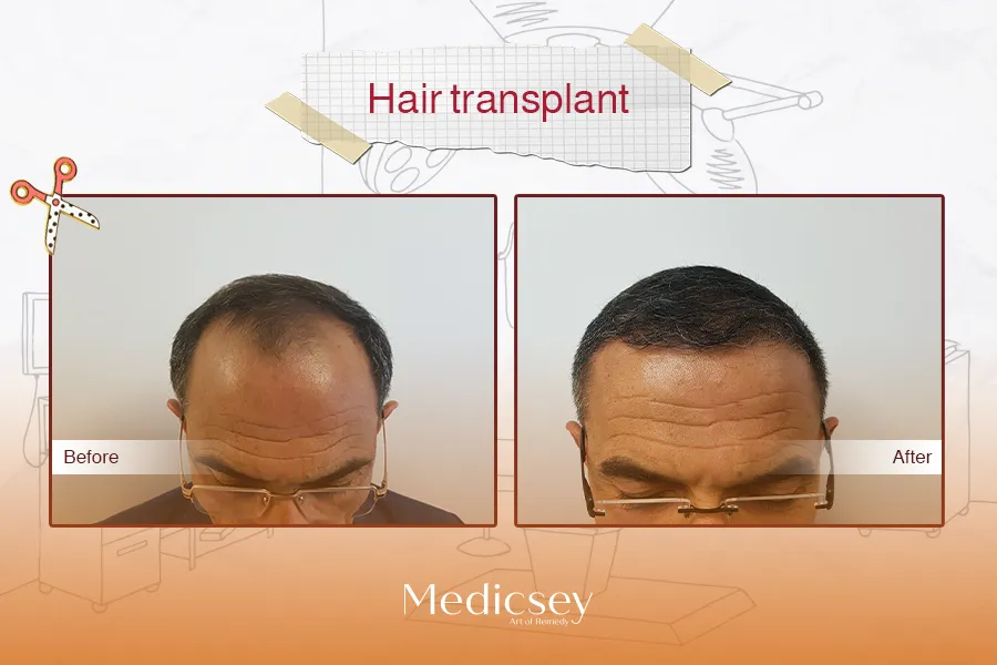 Haartransplantation