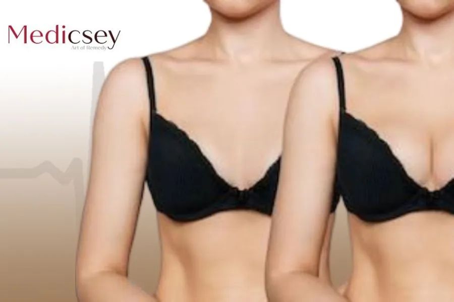 All About the Types of Breast Implants in Turkey in 2024