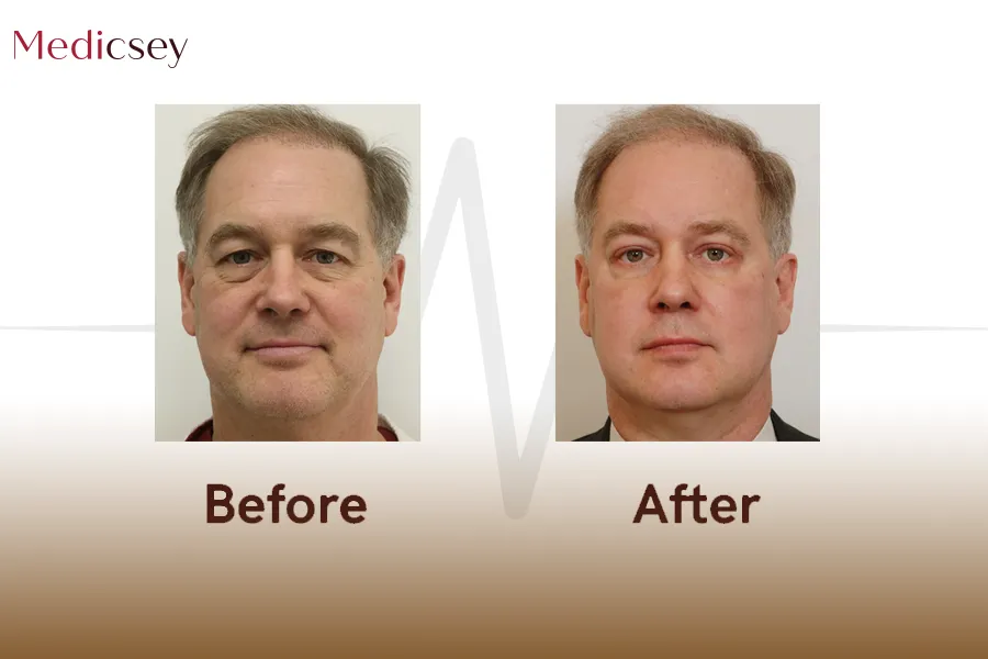 Blepharoplasty
