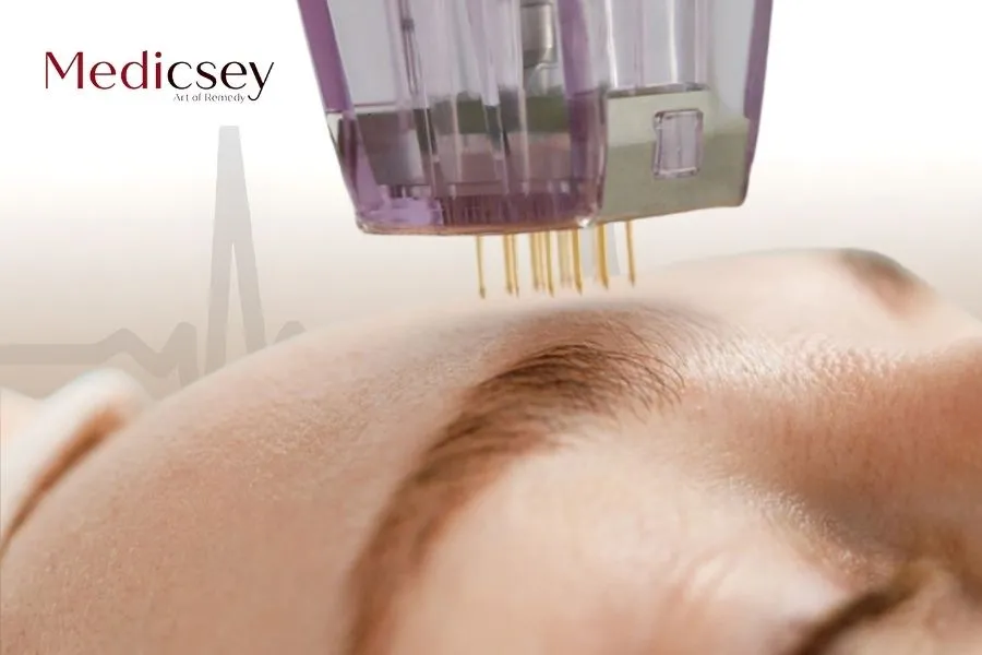 Microneedling in Istanbul: Technology to Improve Skin Quality 