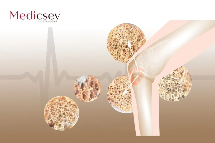 عملية استبدال مفصل الركبة في تركيا