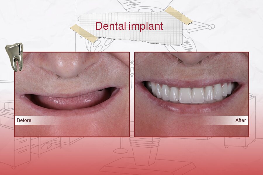 Dental Implants