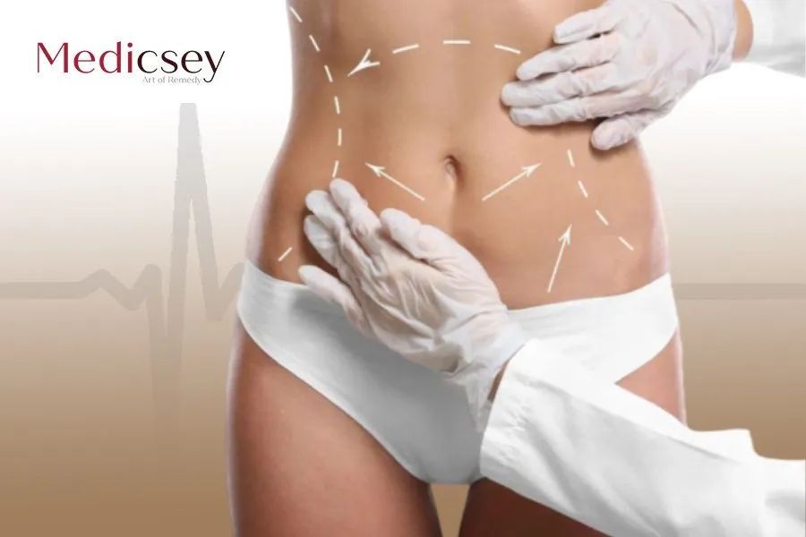 Full Body Liposuction in Turkey: Full Guide and Cost for 2023