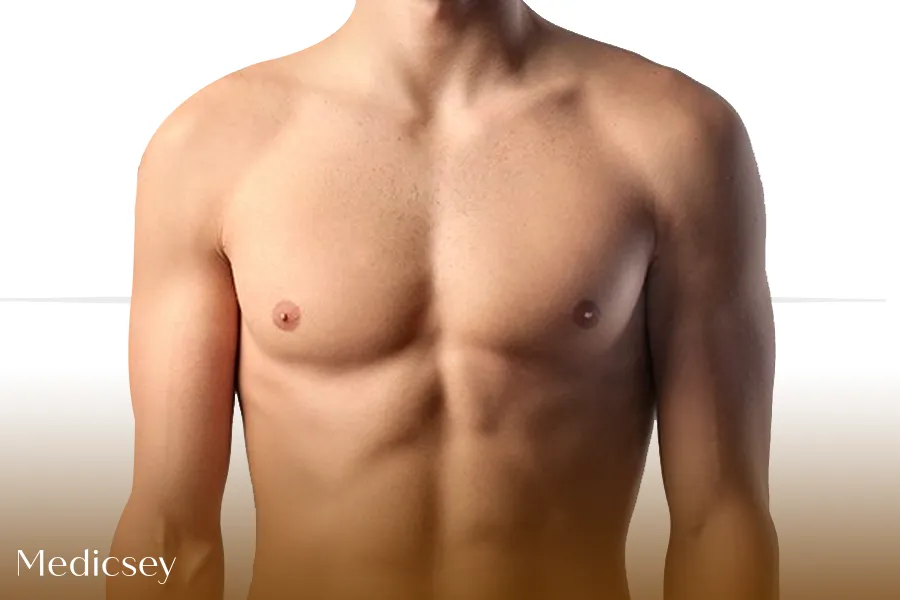 Gynecomastia