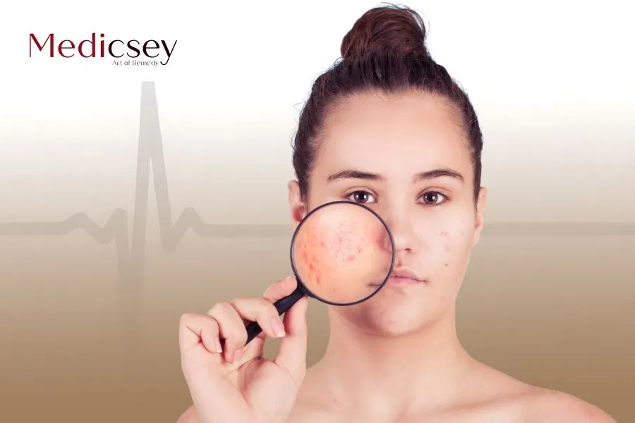 Acne Scar Treatment with Subcision in Istanbul