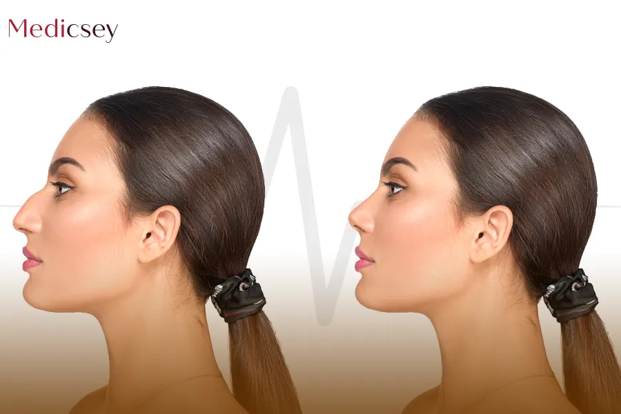 Rhinoplasty