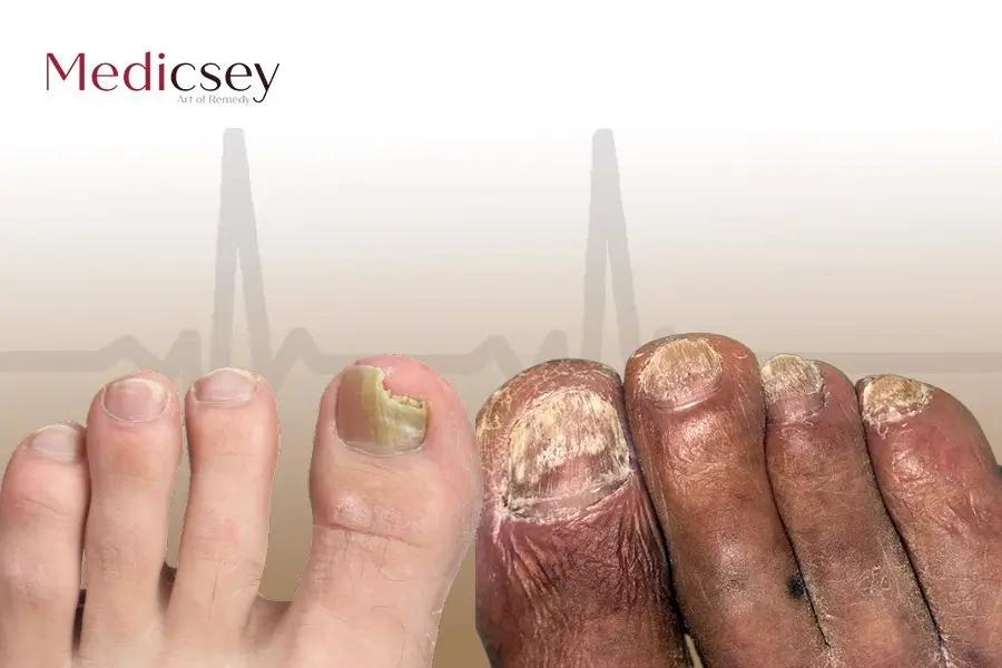 PACT Fungal Nail Treatment - Rightstep Podiatry