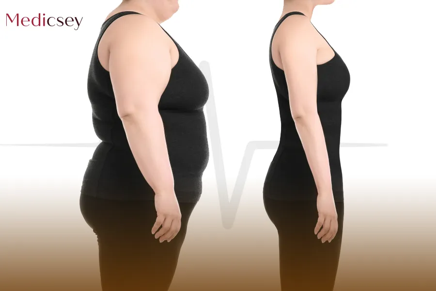 Liposuction