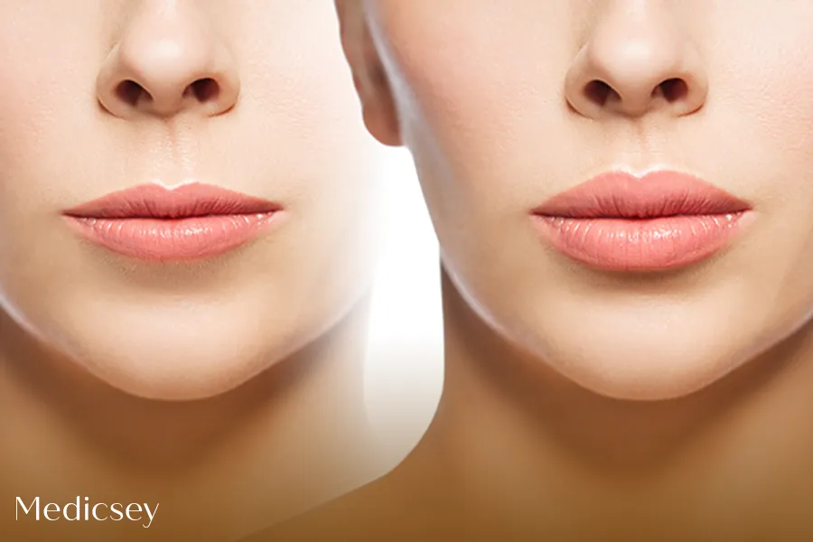 Lip Lift