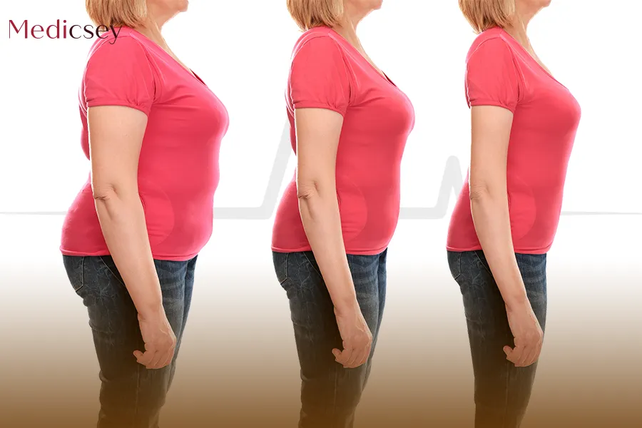 Sleeve Gastrectomy