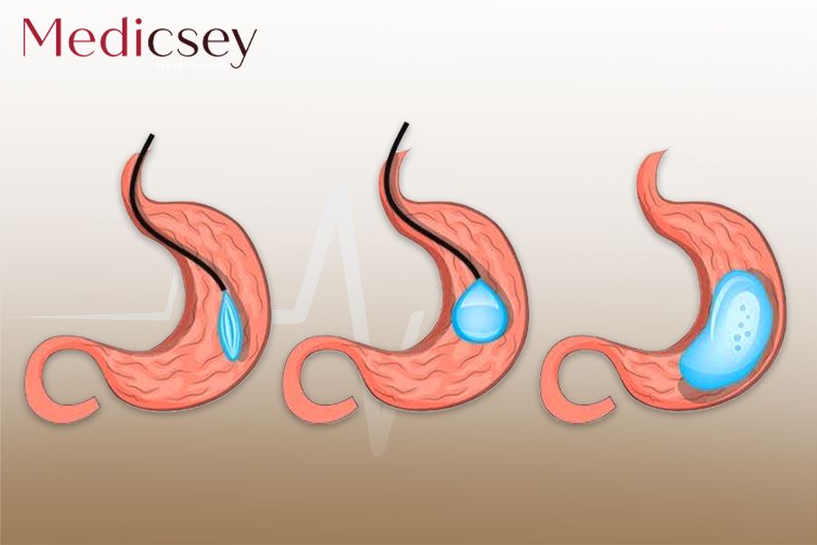 Types of gastric balloon in Turkey