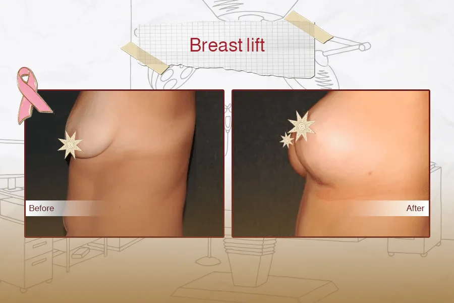 Breast implant