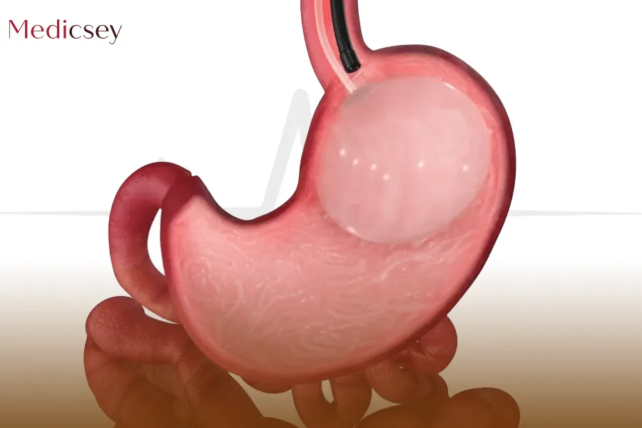 Gastric balloon