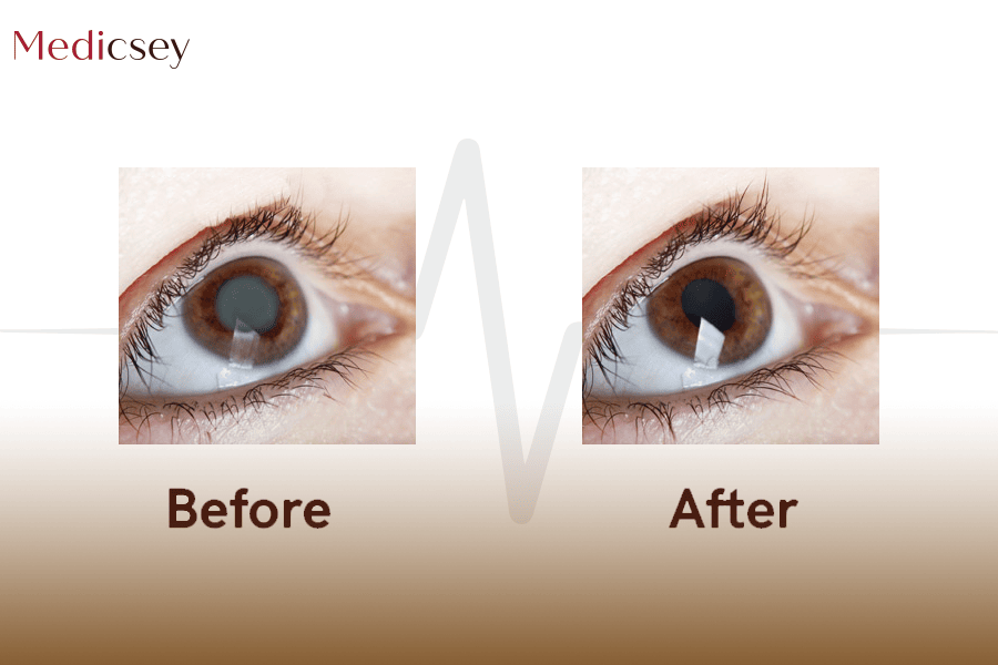 Cataract Surgery
