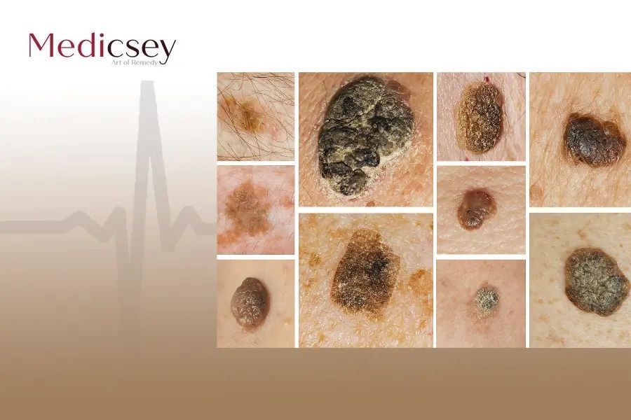 Causes and treatment of seborrheic keratosis