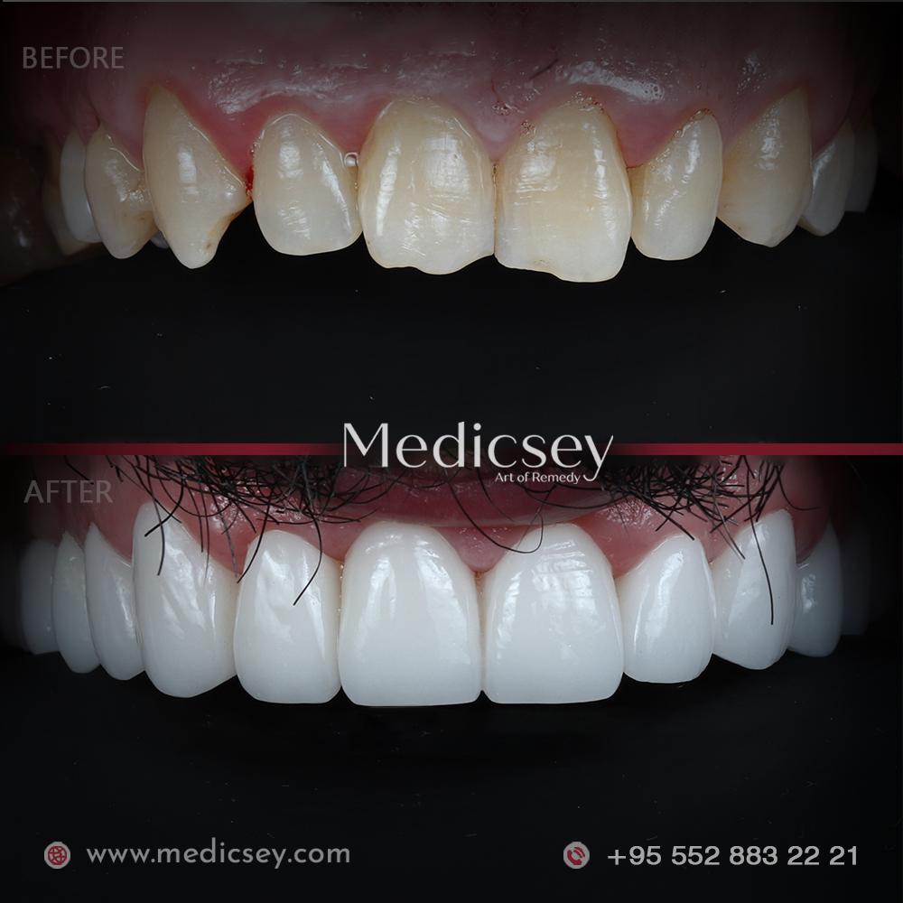 Zirconium Crowns