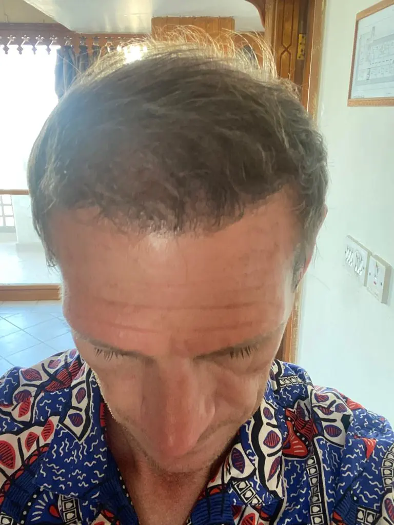 زراعة الشعر