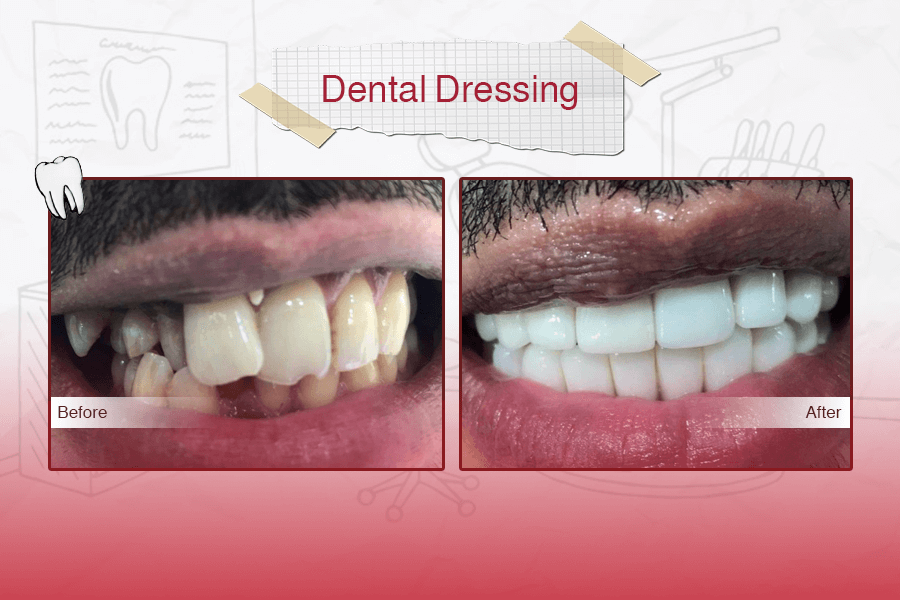 Dental Crowns