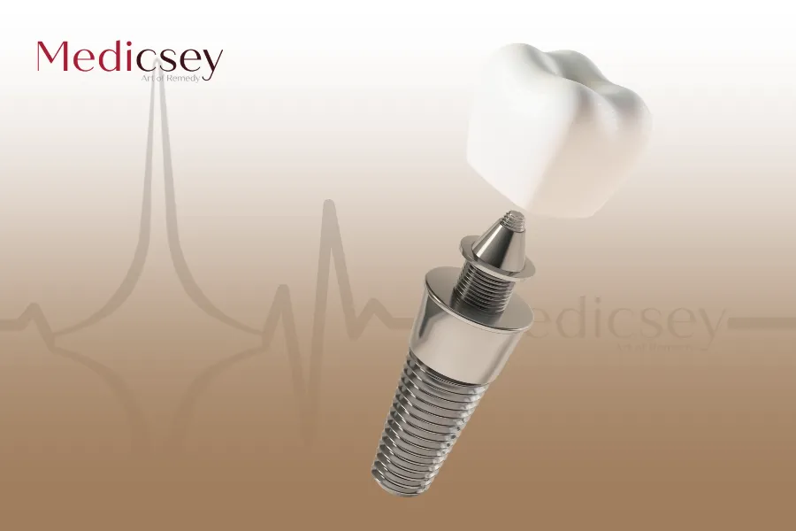 Dental Implants in Syria: Your Comprehensive Guide to Medical Tourism in Syria